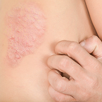 psoriasis