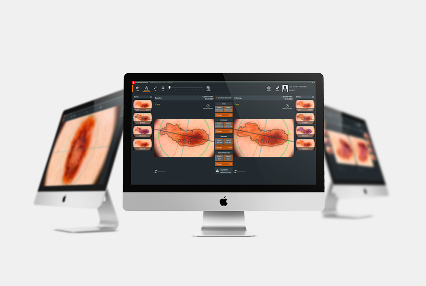 FotoFinder Moleanalyzer pro Moleanalyzer pro for comprehensive support in the assessment of lesions.